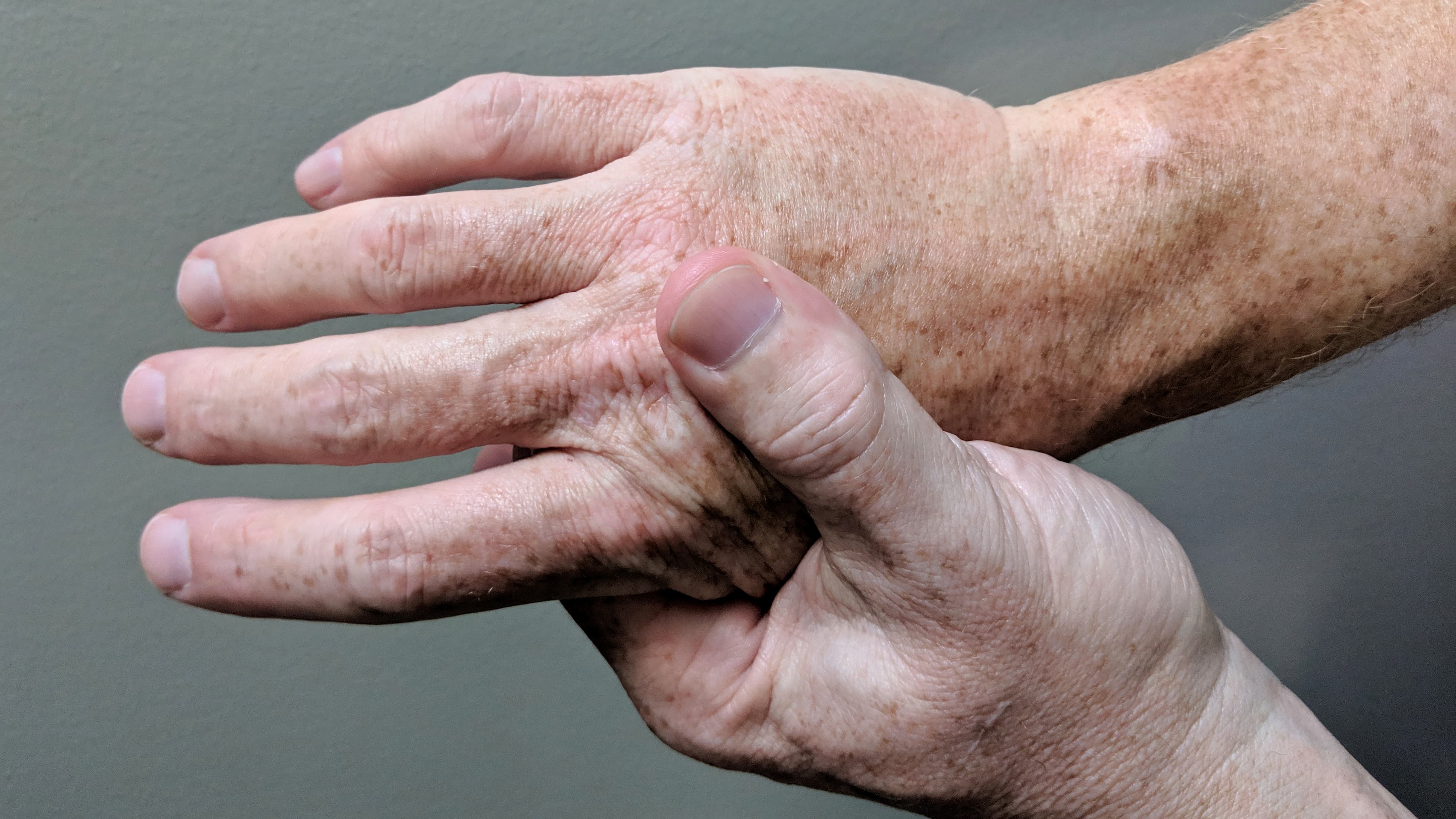 Arthritic hands with fibromyalgia joint pain - chiropractor San Antonio TX