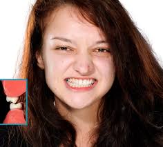 Bruxism jaw clenching teeth grinding treatment - chiropractor San Antonio TX