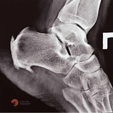 Heel spur calcaneal spur treatment shockwave therapy chiropractor San Antonio TX