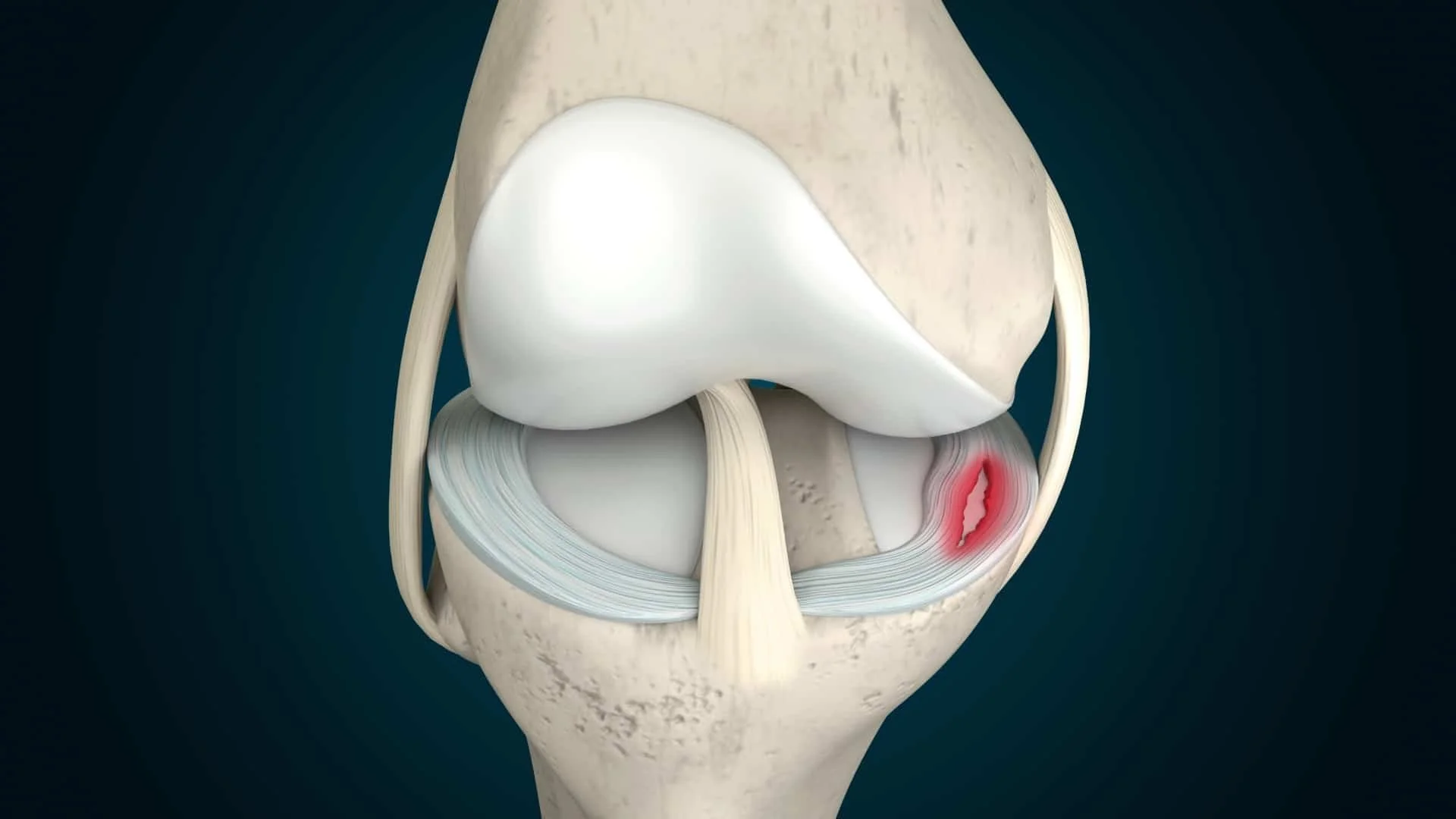 Anatomical diagram of knee meniscus injury - chiropractor San Antonio TX