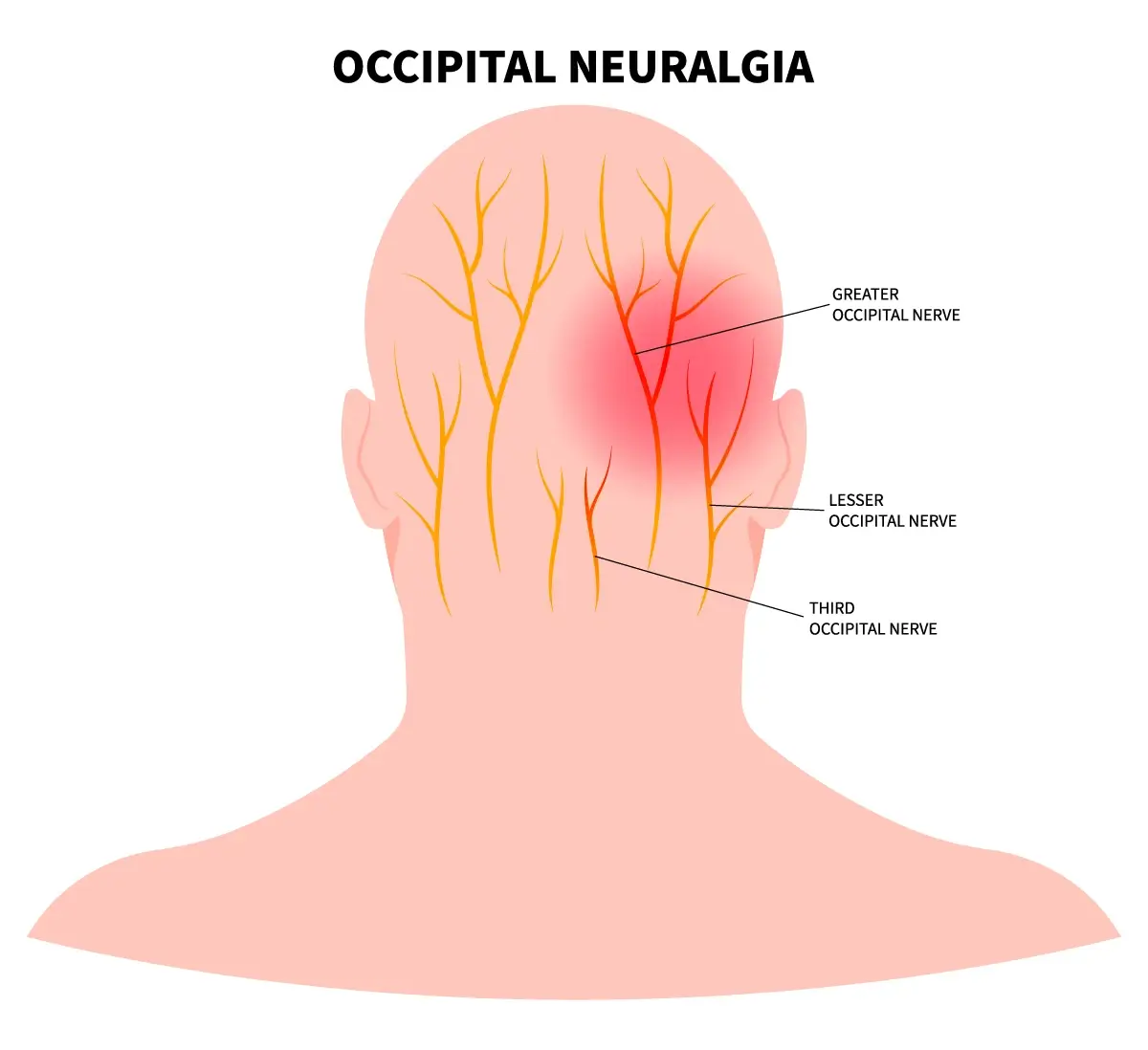 Occipital Neuralgia Chiropractor in San Antonio, TX | Dr. Dan Foss