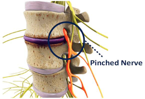 Pinched nerve compression in spine - chiropractor San Antonio TX