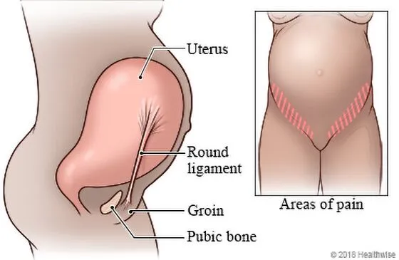 Round ligament pain during pregnancy - chiropractor San Antonio TX