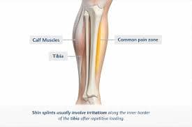 Tibia bone anatomy showing shin splints medial tibial stress syndrome - chiropractor San Antonio TX