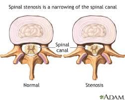 Spinal Stenosis Chiropractor in San Antonio, TX | Dr. Dan Foss