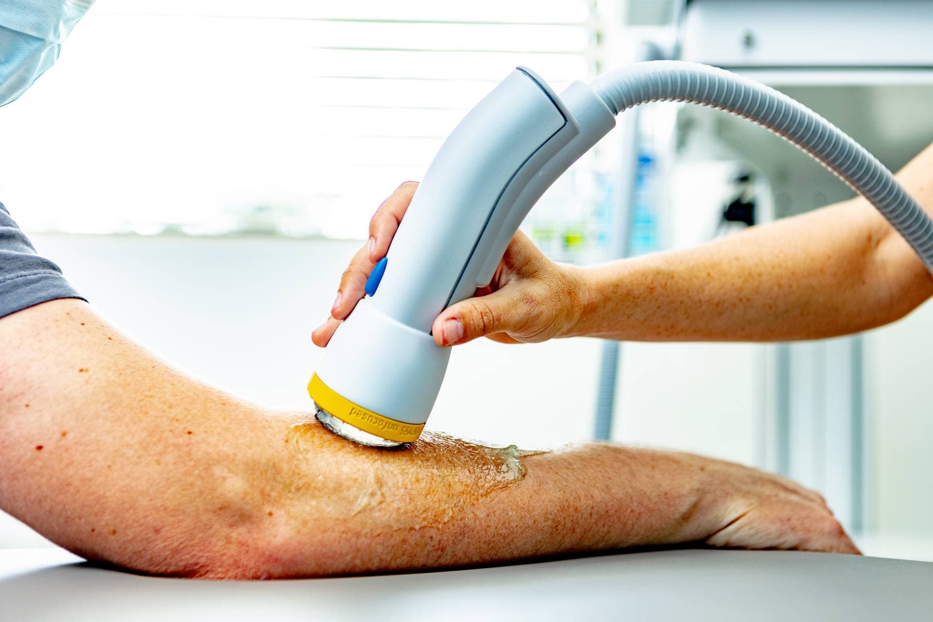 SoftWave therapy treatment